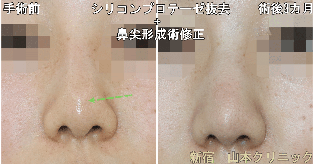 鼻プロテーゼ シリコン 抜いても変わらないって そんなに小さいの 他院修正術 新宿 山本クリニック Note