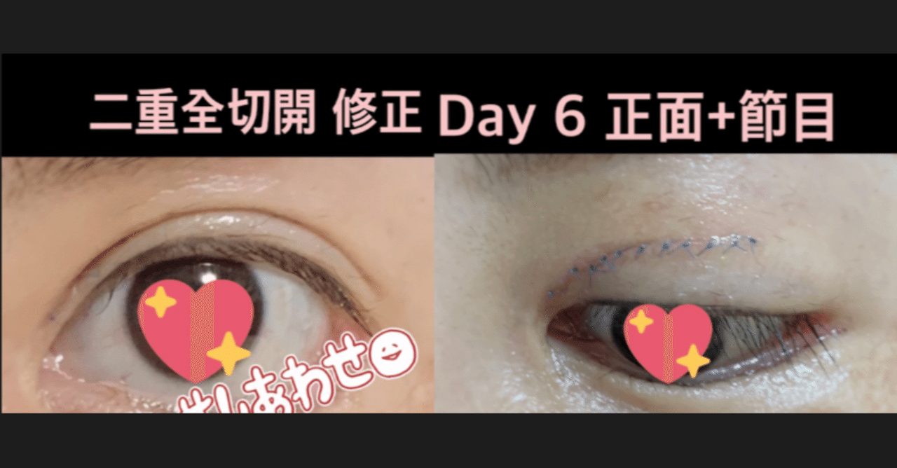 二重全切開 クリニックに関して ごますけ Note 二重全切開 クリニックに関して ごますけ Note