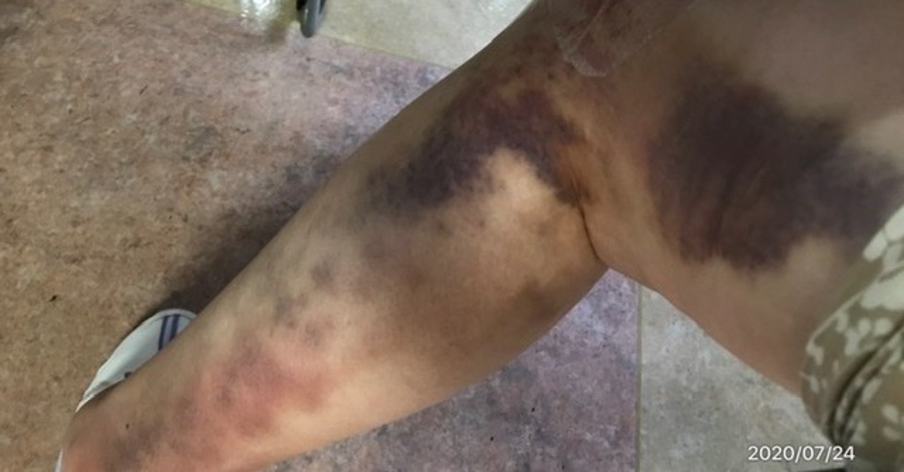 青タンって Naoko Nomigawa Note