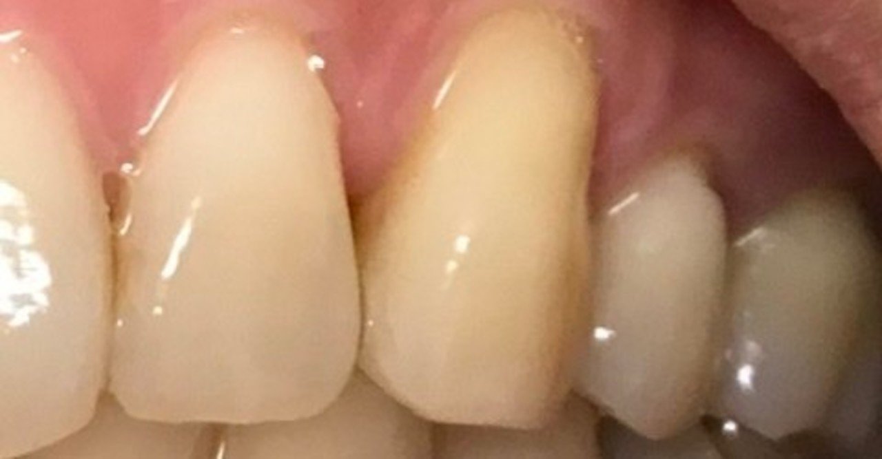 フラクション アブ 歯がしみる！！！歯と歯ぐきの境目にできた欠損『Abfraction アブフラクション』は、大切な歯からのSOS!