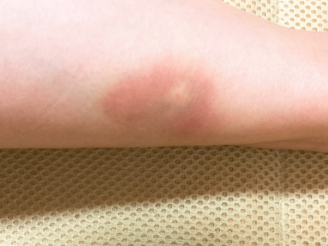 刺され ひどい 写真 腫れ 虫