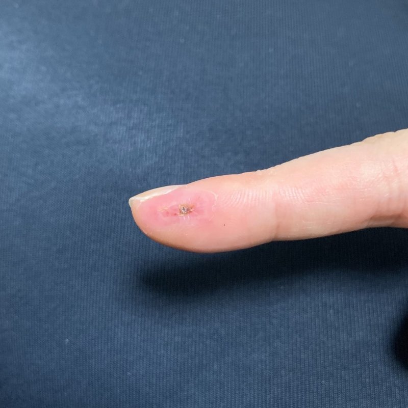 カッターで深く指を切った怪我にキズパワーパッドで湿潤療法した話 46番 Note