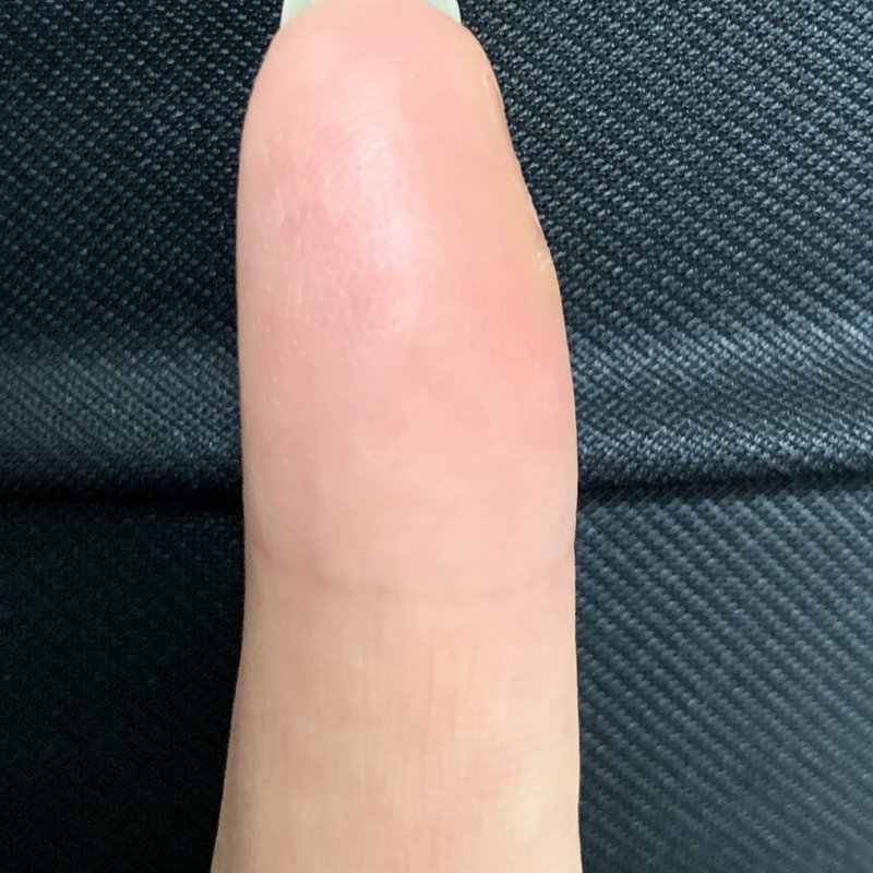 カッターで深く指を切った怪我にキズパワーパッドで湿潤療法した話 46番 Note カッターで深く指を切った怪我にキズパワーパッドで湿潤療法した話 46番 Note
