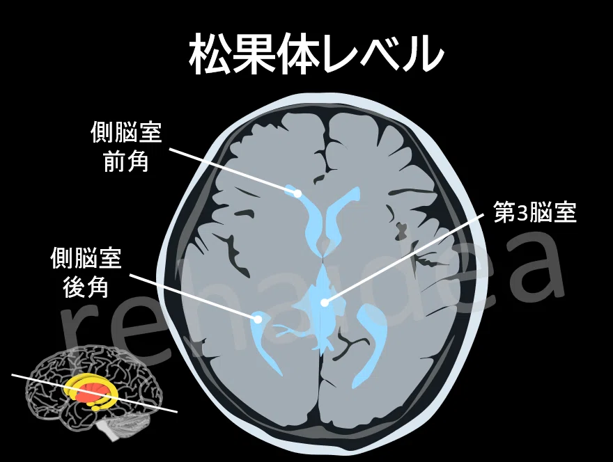 レンズ核（被殻+淡蒼球）を脳画像から簡単に見つける方法｜rehaidea