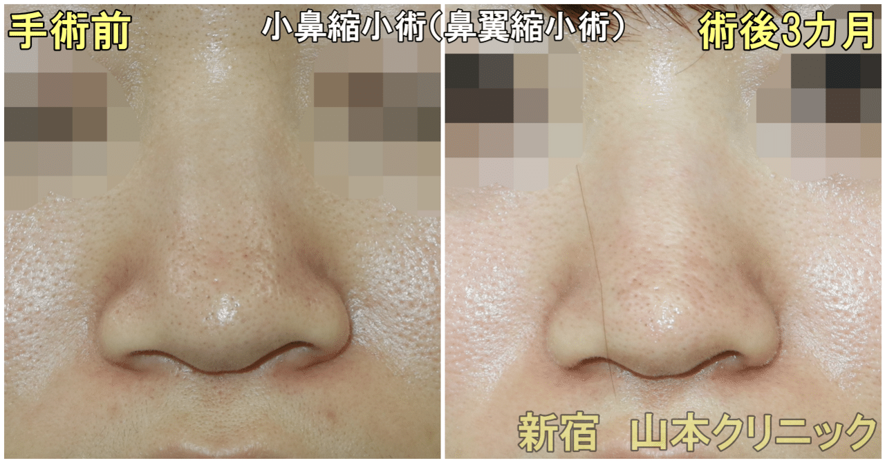 小鼻縮小術 1か月でどうなった 新宿 山本クリニック Note
