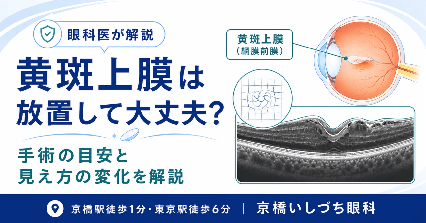 黄斑 前 膜 手術 成功 率