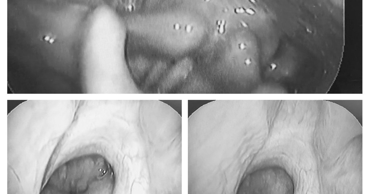 リップノイズ 広義 との戦い 序章 理系ナレーター まゆみ らっこ Note
