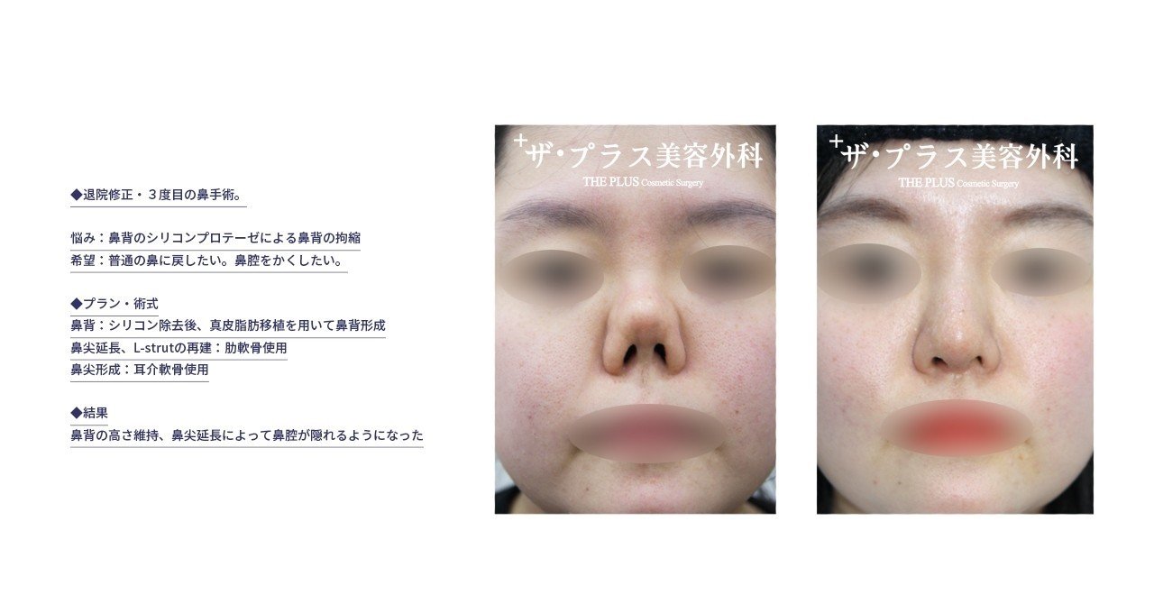 鼻整形を検討している全ての方へ｜ザ・プラス美容外科 東京代官山