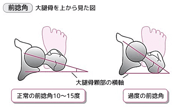 前捻角