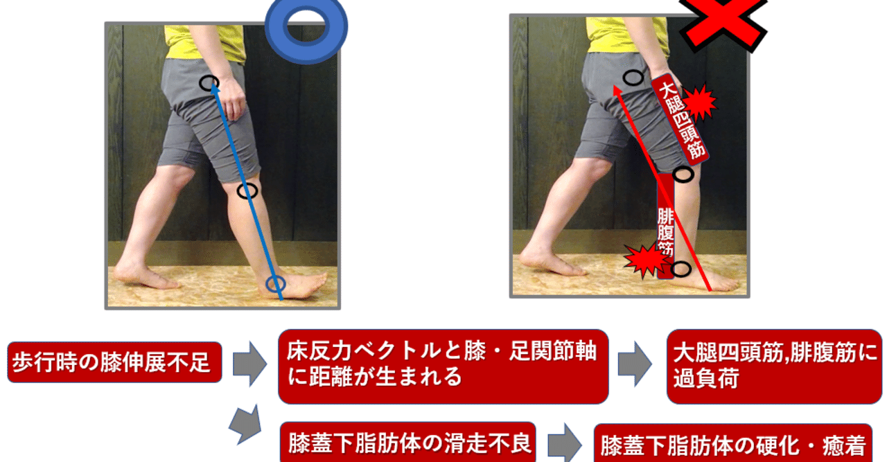 膝関節 第9回 《屈曲拘縮》｜上田浩司（理学療法士）