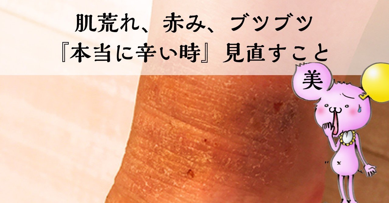 肌荒れ 赤み ブツブツ アンダーヘア 陰毛 部分の赤み炎症トラブルを防止するには Documents Openideo Com