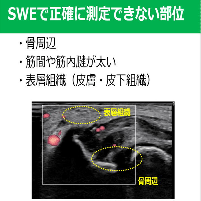 肘mcl損傷後のエコー評価 臨床にどう生かす Y K Note