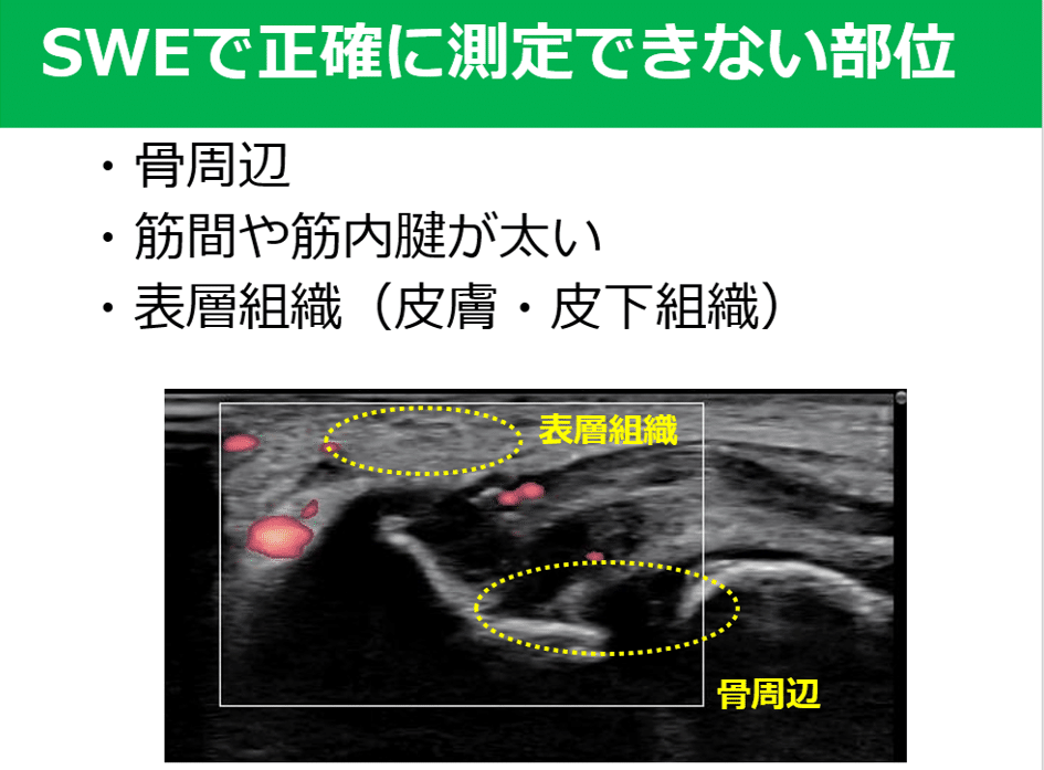肘mcl損傷後のエコー評価 臨床にどう生かす Y K Note 肘mcl損傷後のエコー評価 臨床にどう生かす Y K Note