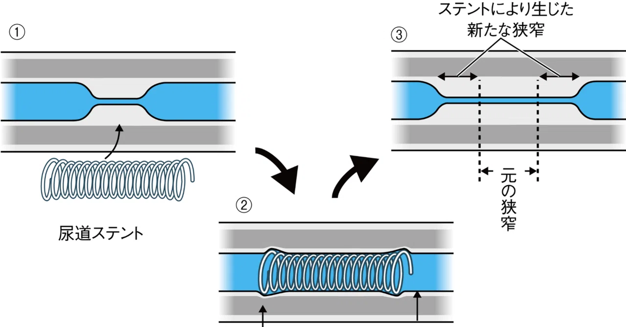 [Textbook of Urethral Stricture Part 153] Why Stents Are Not ...