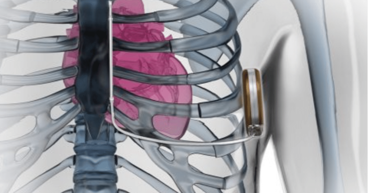 植込み型除細動器とは何ですか?