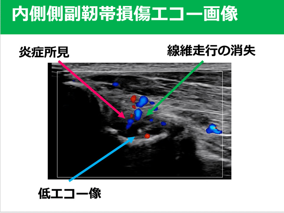 肘mcl損傷後のエコー評価 臨床にどう生かす Y K Note 肘mcl損傷後のエコー評価 臨床にどう生かす Y K Note