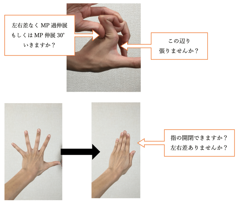 手の使いづらさの原因は 脳外ブログ Note 手の使いづらさの原因は 脳外ブログ Note