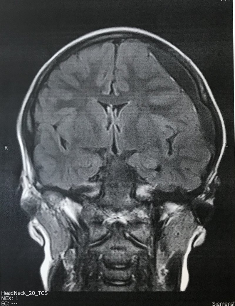 嚢胞 くも膜 くも膜嚢胞の症状や原因、CT・MRI画像所見は？