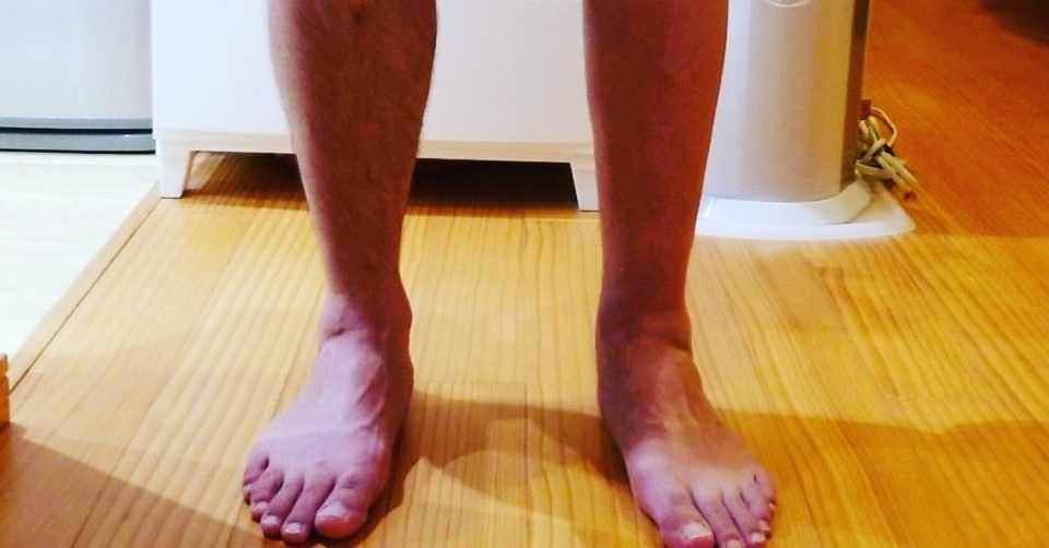 アキレス腱治療の経過 モヤイ Note