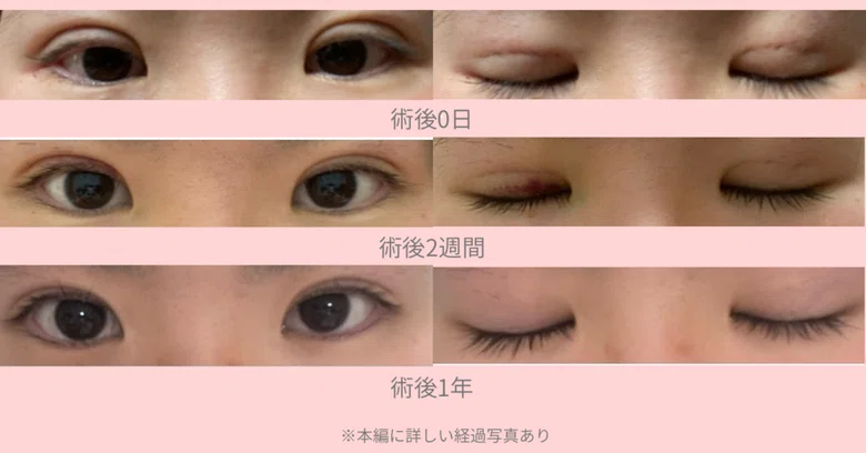 [Full Photo Disclosure] Double Eyelid Burial Method Downtime: Days 0 to ...