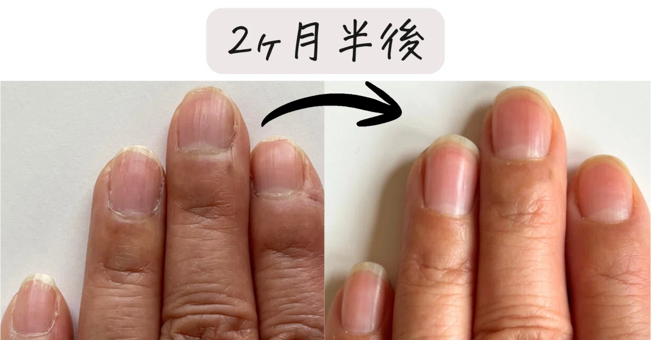 Are vertical nail ridges just an inevitable part of aging? The ...