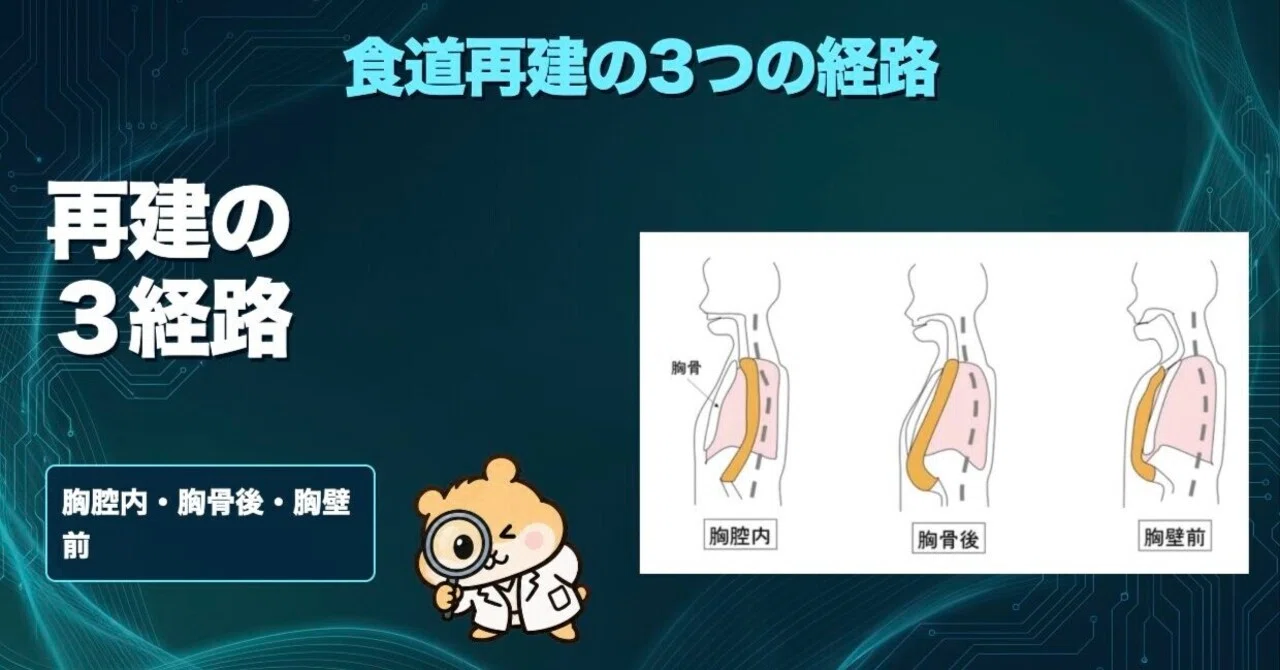 Three Routes for Esophageal Reconstruction (Intrathoracic, Retrosternal ...