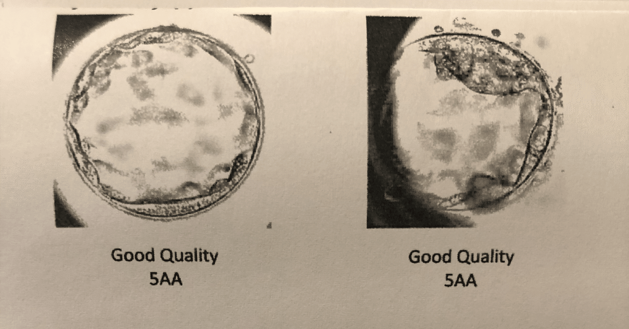 胚盤胞移植 Bt2 胚盤胞移植後 にゃお Note