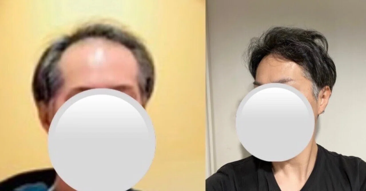 100 Questions for a 43-Year-Old Man Who Had 4,800 Grafts Transplanted ...