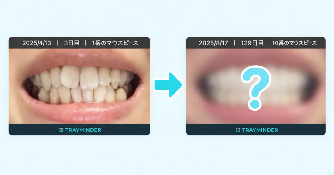 [With Photos] Invisalign Progress: How Much My Teeth Changed in 4 ...