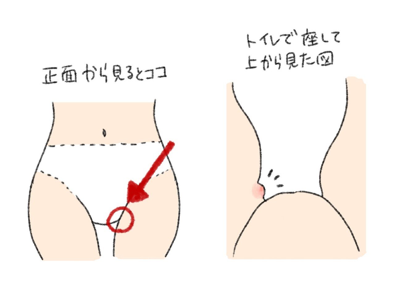 パンツのゴムでできたおできの記録 F Note パンツのゴムでできたおできの記録 F Note