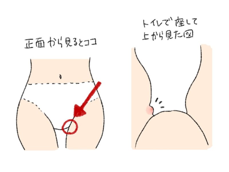 パンツのゴムでできたおできの記録 F Note