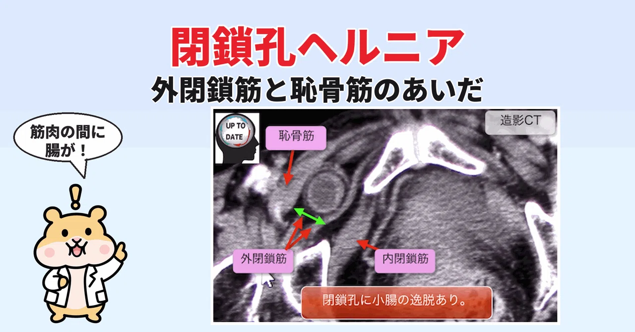 Obturator Hernia on CT: Bowel Protruding Between the External Obturator ...