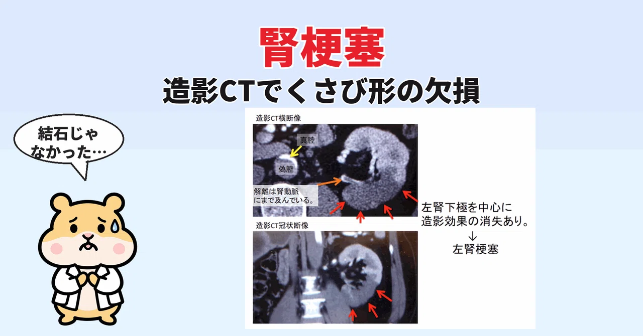 Wedge Infarction Renal infarction is not visible on plain CT | Wedge-shaped defects on ...