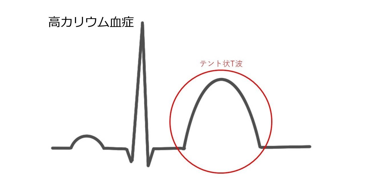 高カリウム血症と薬剤 みや 薬剤師 Note