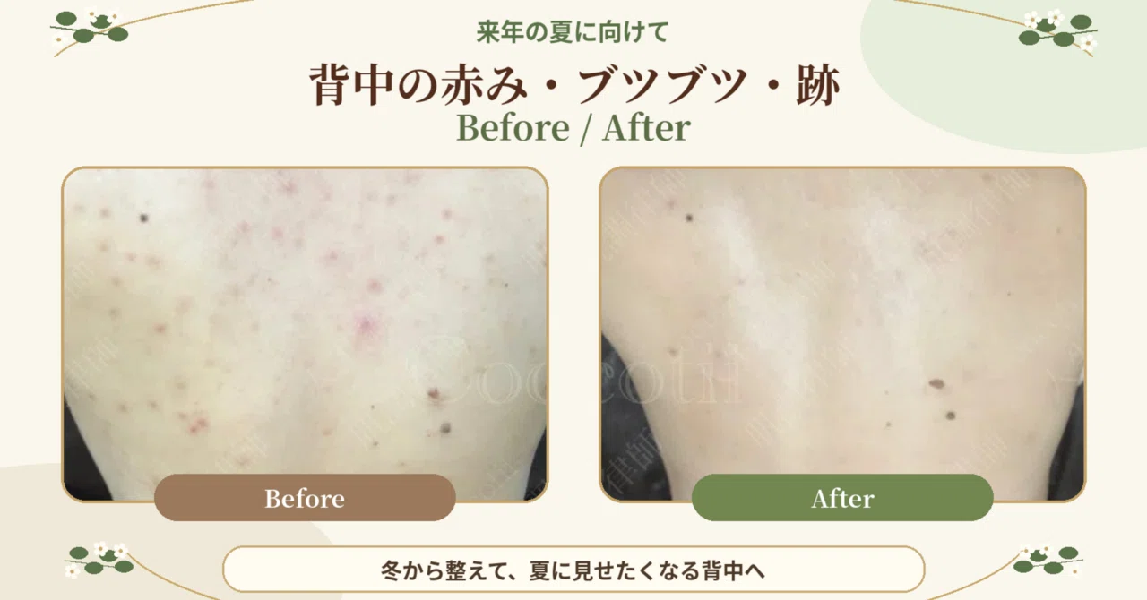 26.10.22 Start back care now for next summer｜肌の道｜グリーンピール症例研究所