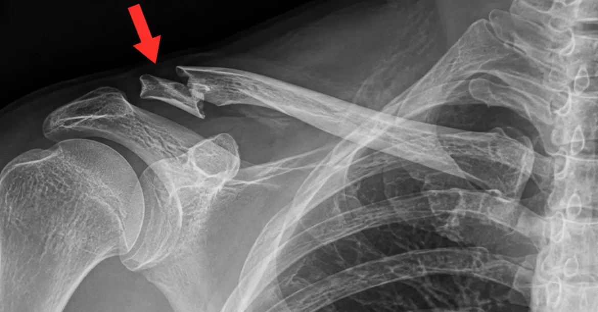 Fractured collarbone and ribs. I was told it would take one month for ...