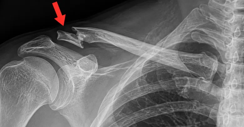 Fractured collarbone and ribs. I was told it would take one month for ...