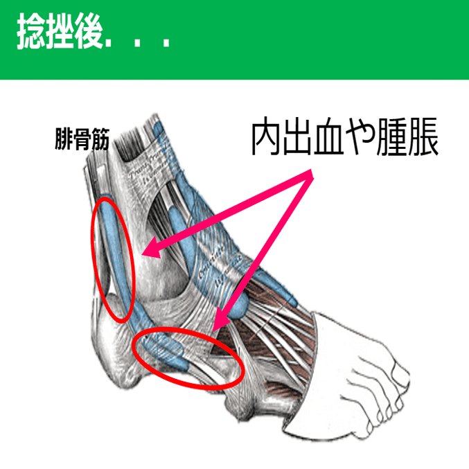 以外と身近に生じている腓骨筋損傷 Y K Note