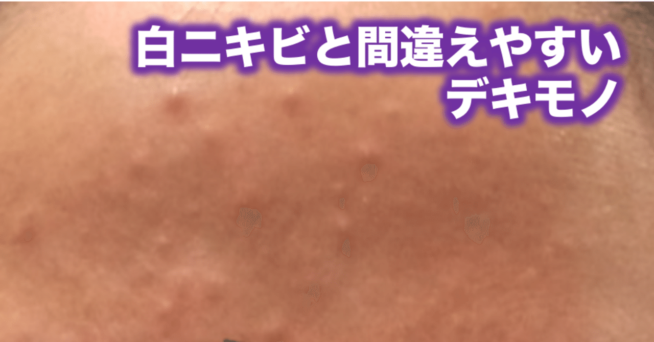 白ニキビと間違えやすいデキモノ 片柳ちひろ ニキビ博士 Note