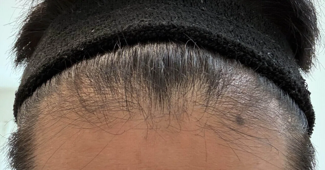 [41 years old, 12 years of AGA treatment] Revealing the current state ...