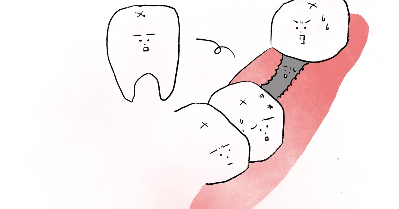 The story of being recommended an implant｜なみさ
