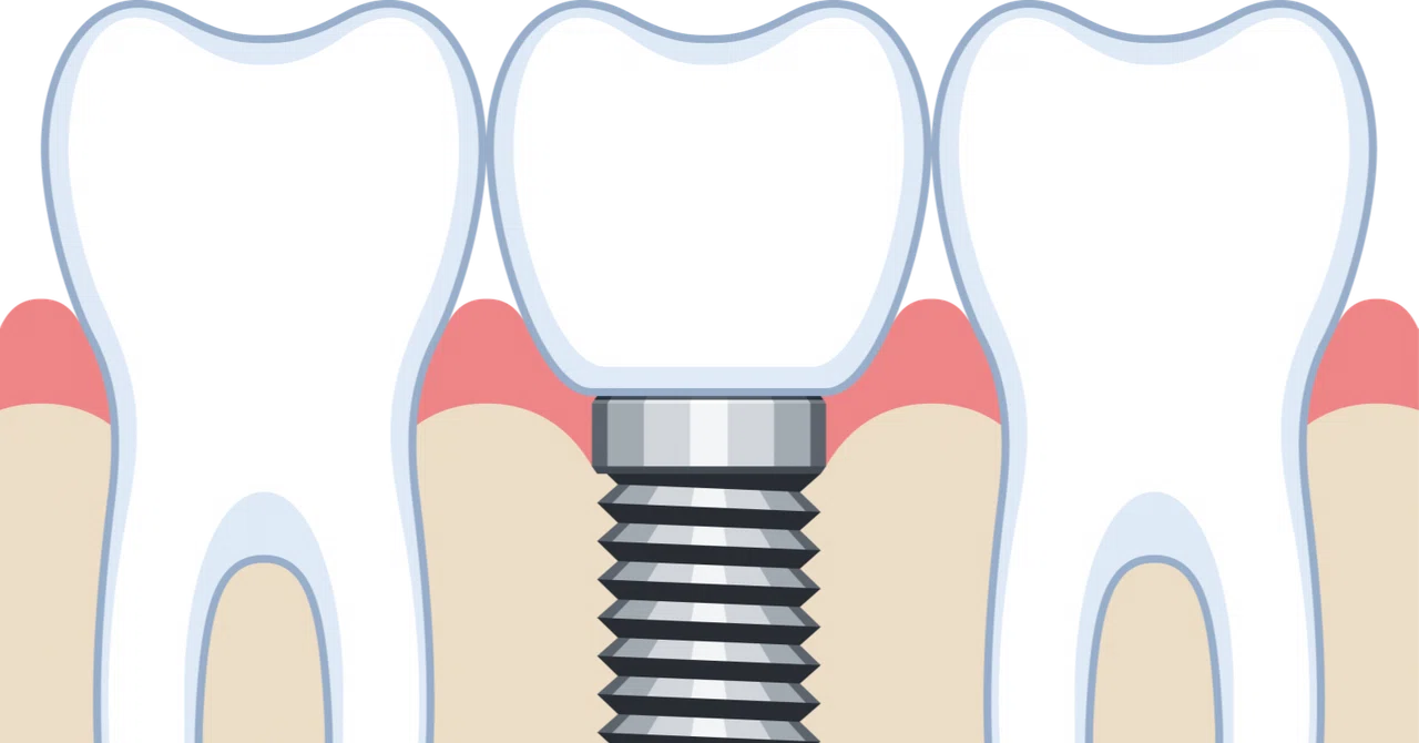 I Tried Getting Implants in Korea! Part 5: Subsequent Progress｜ウィズ
