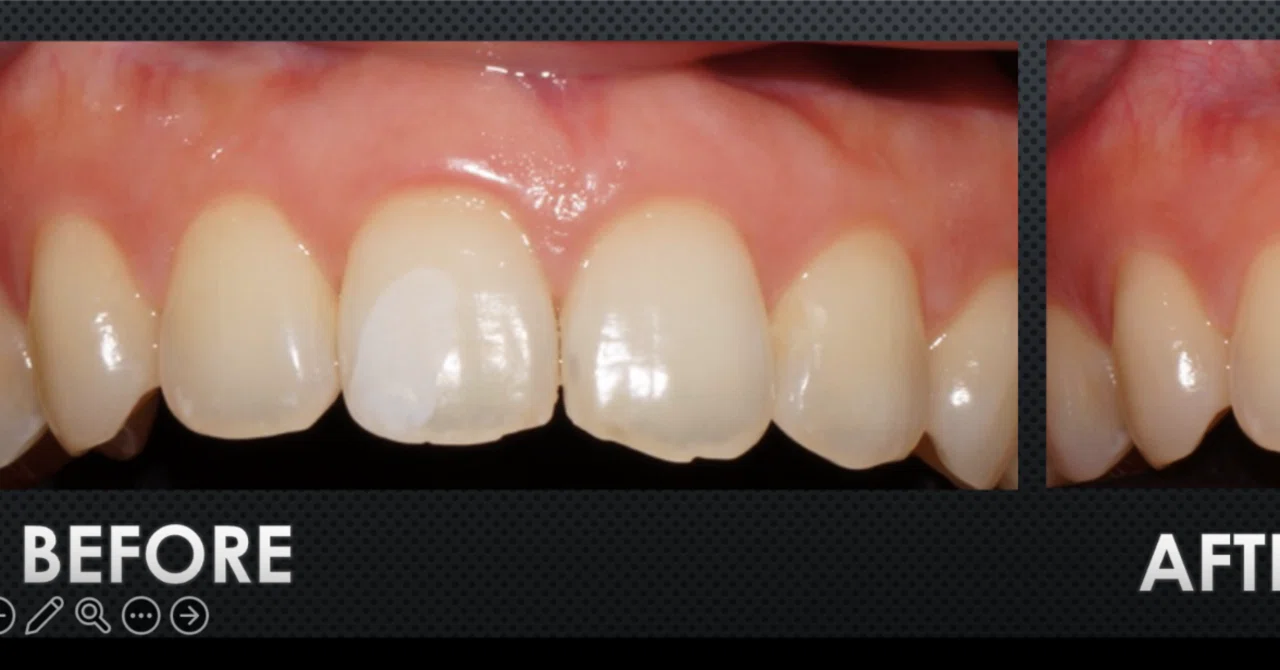 Can white spots become less noticeable with a single Icon treatment? A ...