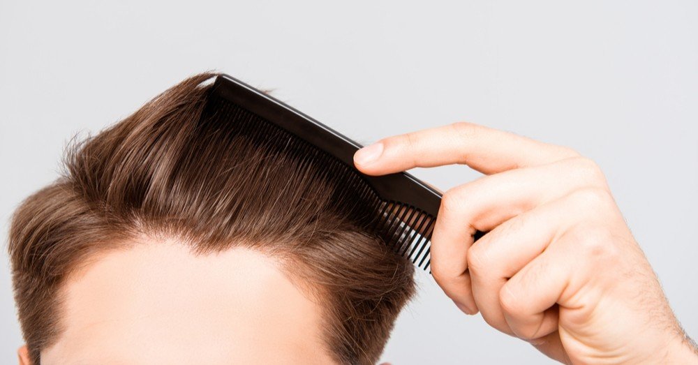 広いおでこを狭くしたい 植毛がおすすめ Miyaco Note