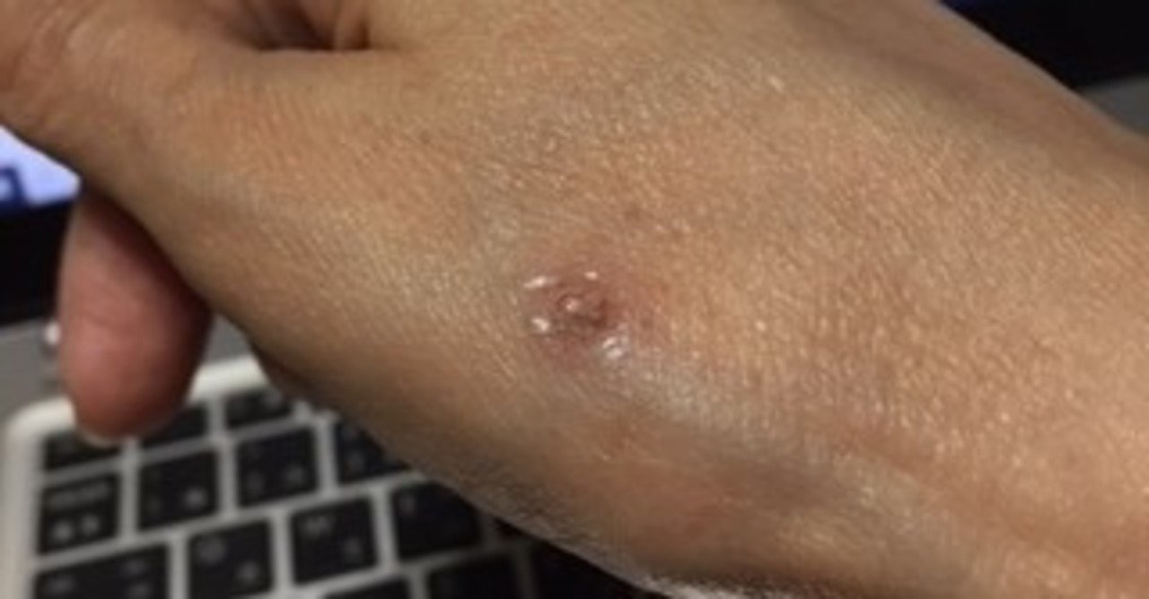 イボコロリで 手のシミがとれるか試してみた Kikomama Note