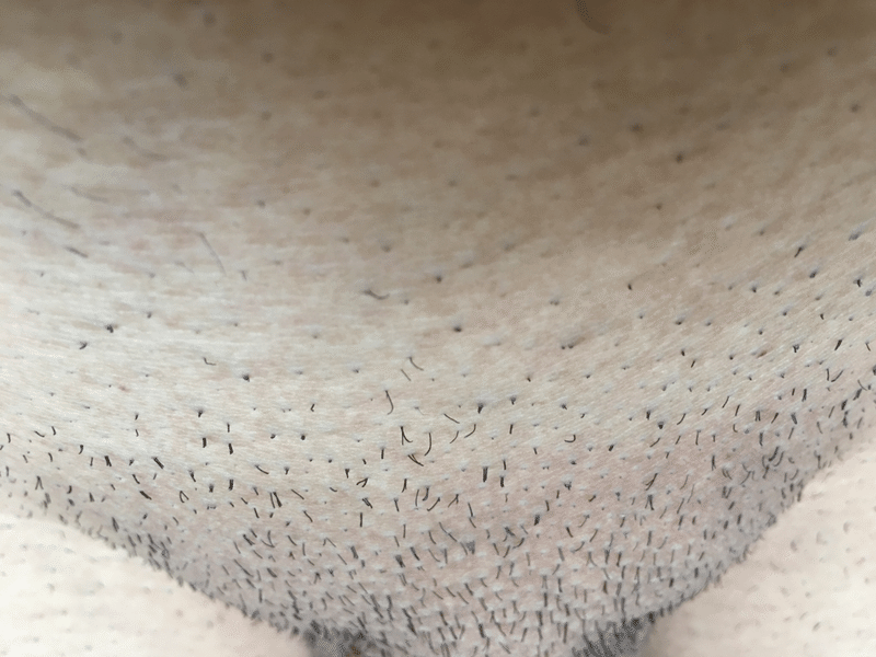 Vio2 メンズvio脱毛 初体験後の経過観察 写真あり Kei S Aha Note Vio2 メンズvio脱毛 初体験後の経過観察 写真あり Kei S Aha Note