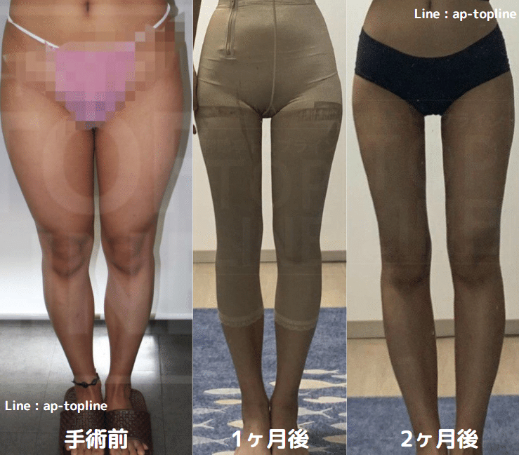 1日で全身の脂肪吸引は可能か 狎鴎亭topline Note