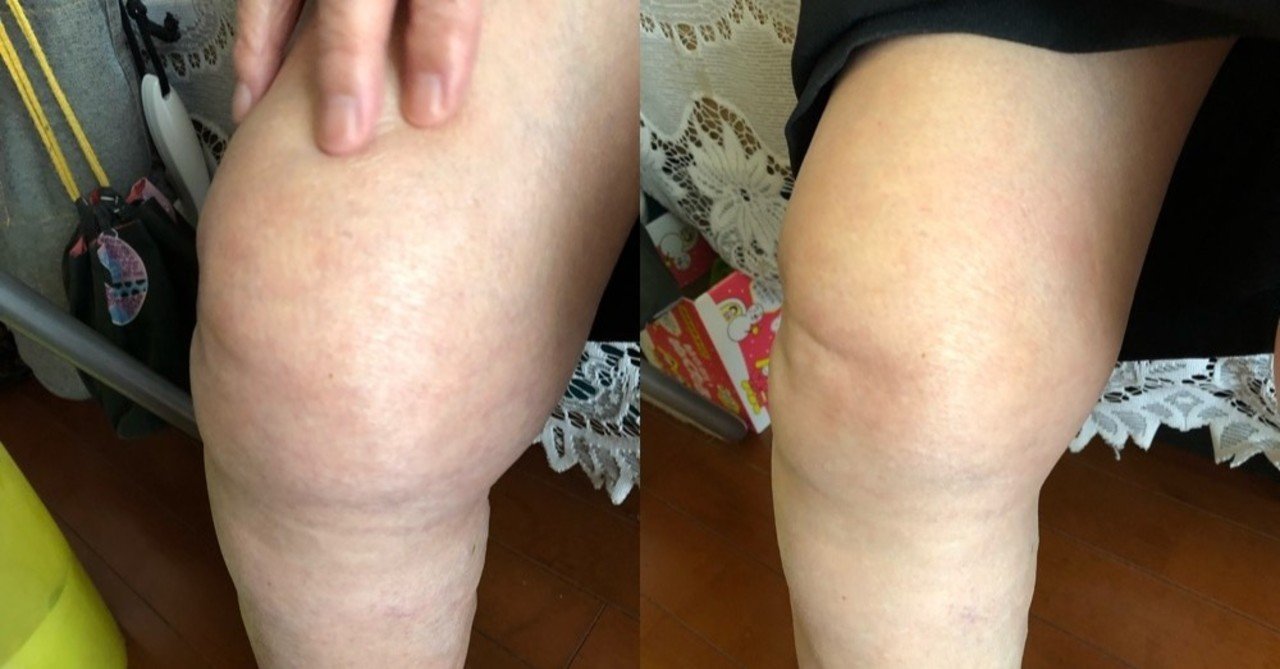 天城流湯治法との出会い！私も膝痛だった！ 一撃で膝痛が楽になる