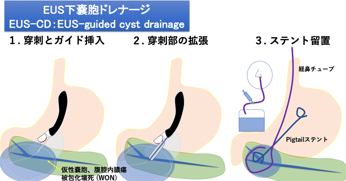世界一やさしいEUS下嚢胞ドレナージの教科書【処置成功のコツと