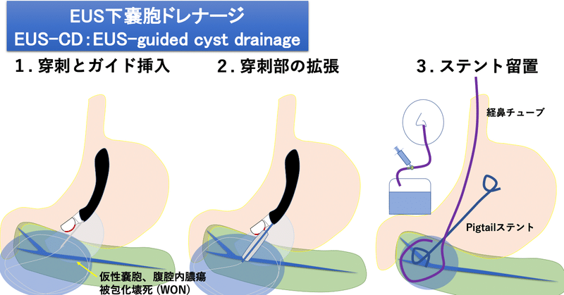 世界一やさしいEUS下嚢胞ドレナージの教科書【処置成功のコツと落とし穴から病棟マネジメントまで】